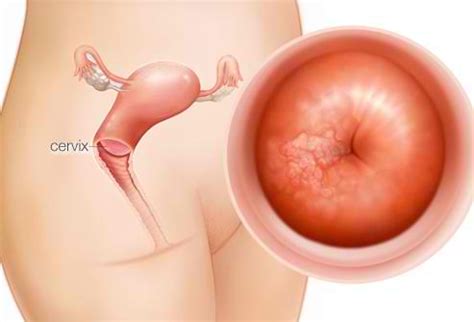 The most common symptom of cervical cancer is abnormal bleeding. Cervical Cancer | Healthy Tips