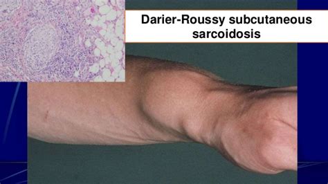 Darier's sign is a change observed after stroking lesions on the skin of a person with systemic mastocytosis or urticaria pigmentosa. Signs in dermatology.pptx