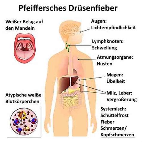 Bei kindern unter zehn jahren verläuft die krankheit meistens beschwerdefrei und bleibt damit unentdeckt. Was ist Pfeiffersches Drüsenfieber?