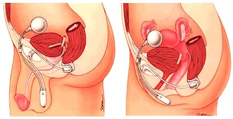 After that, anything can happen. Incontinencia anal | Exploraciones Digestivas Funcionales