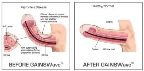 How do we know they're the hottest? Peyronie's Disease Treatment in Metairie, LA- Non-Invasive ...