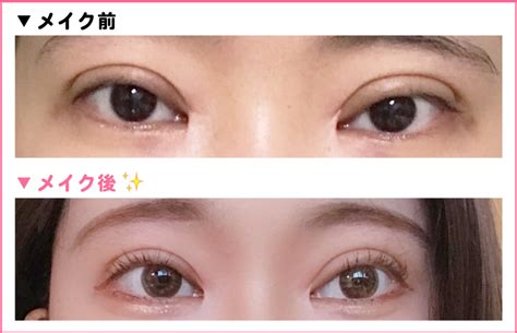 【画像でわかる!】埋没法直後から腫れが引くまでの経過 | Chel ...