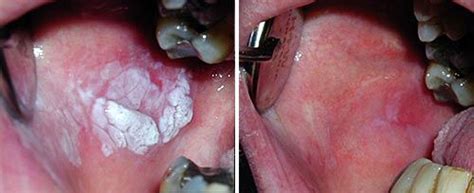 Leukoplakia affects the mucous membranes of the mouth. Fotona UK - Oral Surgery