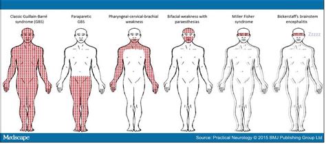 Published online 15 july 2014; NEURO ARGENTINA - FUN.CER.MEN: Síndrome de Guillain-Barré ...