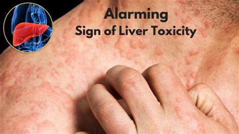 The liver is your largest internal organ. Early Sign & Symptoms of Liver Failure