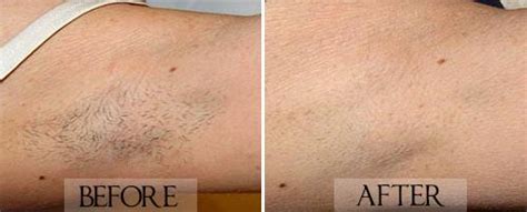 Stefan on laser hair removal service. Best Laser Hair Removal Toronto At Affordable Prices by ...