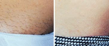 * individual results may vary. Before and After Laser Hair Removal, Beverly Hills, Los ...