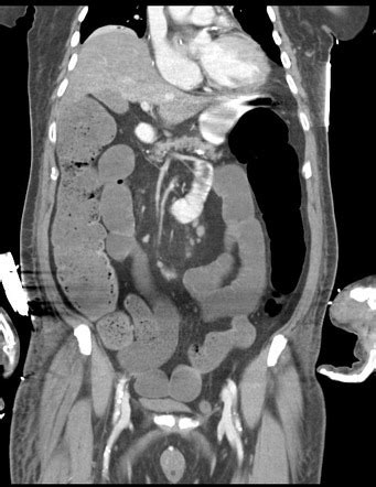 Most cases involve fundoplication, in which a fundic wrap. Large bowel obstruction from incarcerated inguinal hernia | Image | Radiopaedia.org