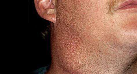 Der herpesvirus, der bei einer erstinfektion zu windpocken führt, löst bei späteren infektionen gürtelrose aus, die mit einem roten ausschlag im rumpfbereich beginnt. Pfeiffersches Drüsenfieber, Mononukleose