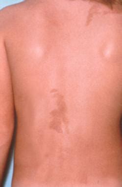 A genetic disorder of bones, skin pigmentation and hormonal problems with premature sexual development. Mc Albright Syndrome | Affects The Bones, Skin ...