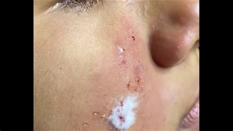 How to remove and prevent milia formation naturally. Milia How to remove blackheads at home part 3 - YouTube