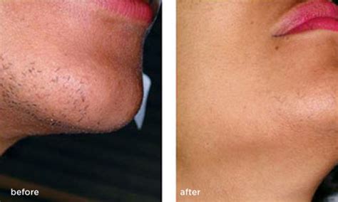 However, this facial hair removal tool can get tedious if you're looking after more than a few stray this hair removal cream is specially formulated for sensitive facial skin. Laser Hair Removal Treatments Before & After Photos