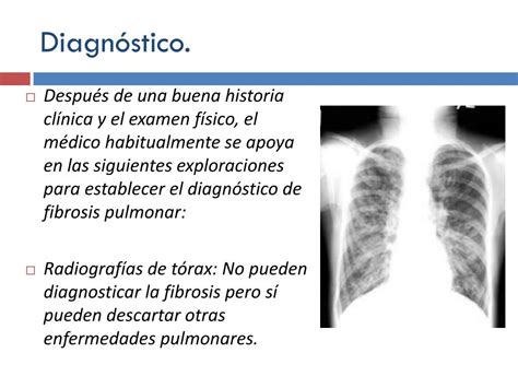 Pulmonary fibrosis has many causes such as exposure to asbestos, infections, lupus, ra, and medication. PPT - FIBROSIS PULMONAR PowerPoint Presentation, free download - ID:2809837