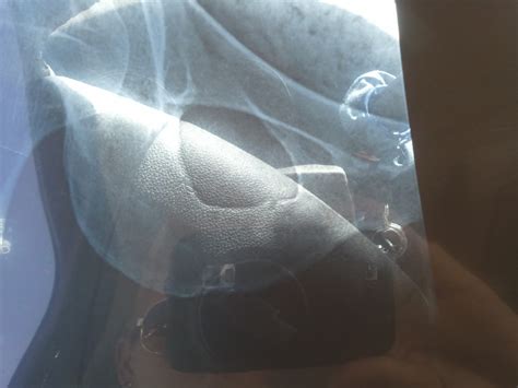 Pubic Ramus Fracture in the Distance Runner | Vivere ...