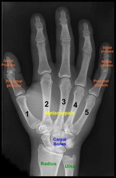Distal to the elbow, the body of the radius continues in an immediate line along the lateral facet of the. high quality hand x-ray with metacarpals, phalanges ...