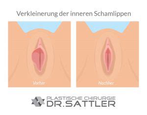 Ich habe mir vor genau 14 tagen die inneren schamlippen bei dr. Schamlippenverkleinerung | Intimchirurgie Hamburg | Dr ...