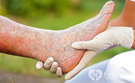 Тромбофлебит нижних конечностей диета Тромбофлебит нижних конечностей - симптомы, лечение, диета, признаки Тромбофлебит нижних конечностей - симптомы, лечение, диета, признаки Тромбофлебит нижних конечностей диета