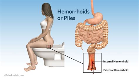 Internal hemorrhoids are located up inside the rectum. Q & A on Hemorrhoid or Piles: Is it a Serious Disease?