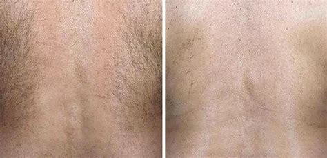 Doctors use lasers to zap hair at its roots and help reduce outbreaks of hidradenitis suppurativa. About Laser Hair Removal | Luxe Laser | Portland, Oregon ...