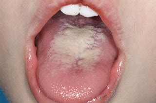 You might notice white spot on the tongue after experiencing discomfort or when checking inside your mouth. Sore or white tongue - NHS - NHS