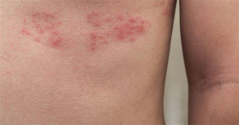 Simak beberapa hal berikut ini. Kisah Terkena Cacar Ular (Herpes Zoster) | Travel and Food