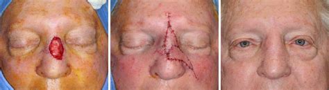 It starts when cells in the skin called merkel cells start to grow out of control. Nasal Skin Graft Revision with Flaps - Skin Cancer and ...