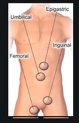 Hernias usually occur in the groin hernia is a common problem. What is Femoral hernia? - Swami Dayanand Naturopathy Hospital