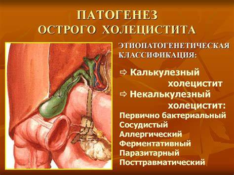 Катаральный холецистит диета Острый холецистит - презентация онлайн Острый холецистит - презентация онлайн Катаральный холецистит диета