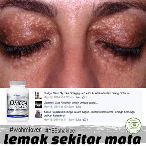 Aku terjumpa satu page fb yg jual produk utk hilangkan biji kolestrol. Badan Sihat Hati Ceria: Cara hilangkan tanda putih ...