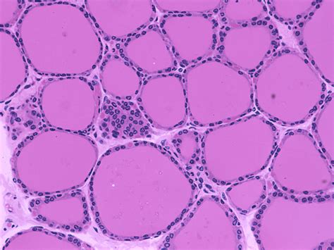 Graves' disease, an autoimmune disorder that causes hyperthyroidism, can lead without treatment, graves' disease can cause serious problems with the heart, bones, muscles, menstrual cycle, and. Histology Gallery