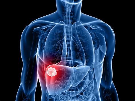 Liver tumor types by relative incidence in adults in the united states (liver cancers in dark red color). Colorectal Cancer Metastasis Associated With Liver ...