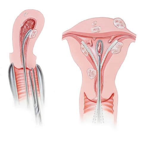 Aborto espontáneo (inpatient care) information by drugs.com, including aborto espontáneo el aborto espontáneo es la pérdida de un feto (bebé no nacido) dentro de las primeras 20 semanas de. Legrado uterino