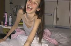 anorexia anorexic irish dublin disappear treatment wasn