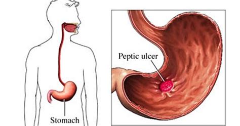 Selanjutnya, zat sisa akan dibuang ke luar dari tubuh melalui urine. Obat Asam Lambung Tradisional Paling Ampuh | Pengobatan ...