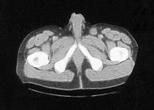 Penile cancer is treatable and completely curable provided you find it in it's early stages. A Case of Metastatic Penile Cancer Showing a Prolonged ...