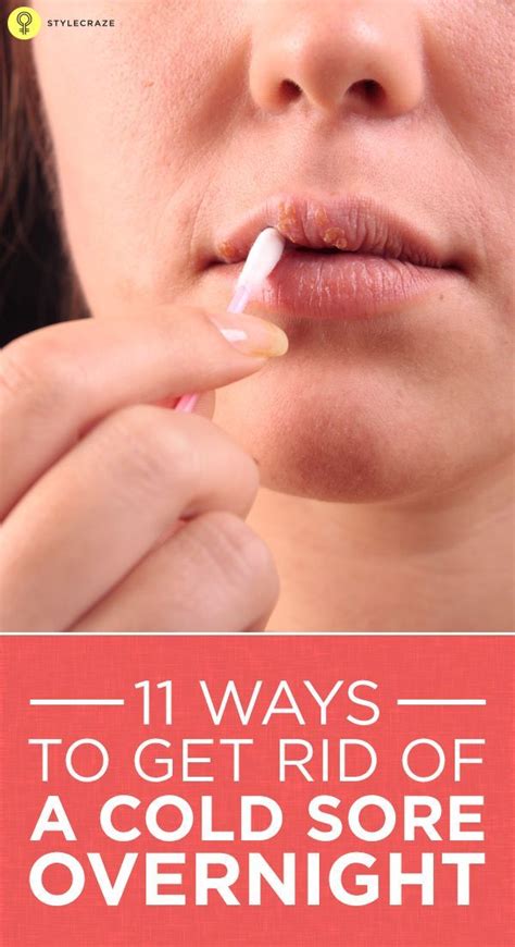 This content is accurate and true to the best of the author's knowledge and does not substitute for diagnosis, prognosis, treatment, prescription, and/or dietary. How To Get Rid Of Cold Sores - 20 Home Remedies And Other ...