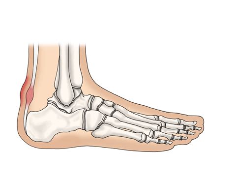 Benannt wird sie nach dem schwedischen chirurgen und orthopäden patrick haglund. Achillodynie - Klinik-Impuls