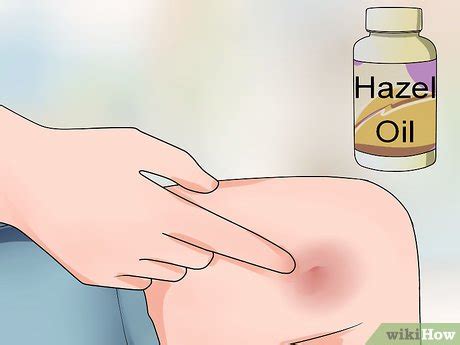 A homeopathic medicine by name of arnica montana taken in repeated doses of 3times aday in 200c potency helps largely in healing bruises any where on the body even of long time back injuries. Sneller van een blauwe plek afkomen - wikiHow