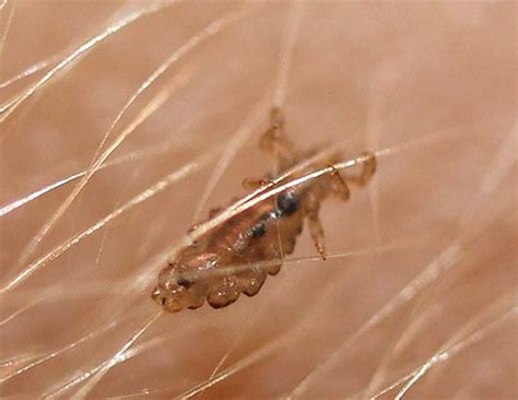 Was sind ihre eltern von beruf? Wie man Nissen und Läuse tötet: Parasiten richtig zerstören