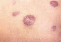 Leukemia cutis is the infiltration of neoplastic leukocytes or their precursors into the skin resulting in clinically identifiable cutaneous lesions. Leukemia cutis | definition of leukemia cutis by Medical ...