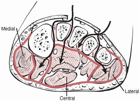 This may result in temporary or permanent damage to muscles and nerves. Acute Compartment Syndrome - TeachMe Orthopedics