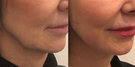 Every minimalism journey is unique, so it's easy to find lots of written words about minimizing and decluttering your home, but harder to find pictures, especially of family homes. Kybella for Jowls: a game changer