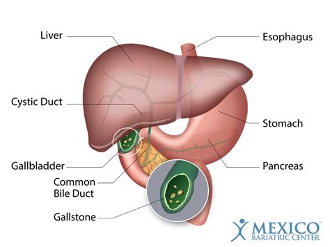 Homeopathy provides a wide range of effective medicines to treat gall stones. How You Know You Have Gallstones: Signs, Symptoms, & Treatment