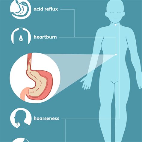 There is a valve at the entrance of your stomach which a ring of muscles called the lower esophageal. What are the common Symptoms of Acid Reflux? | Unrealistic ...