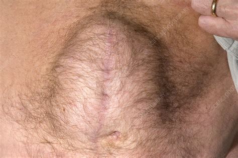 Female with an upper abdominal hernia that developed after a wound infection. Incisional hernia - Stock Image - M330/1600 - Science ...