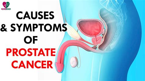 Before a diagnosis blindsides you, make sure you know these common prostate cancer symptoms. Causes and Symptoms of Prostate Cancer - Health Sutra ...