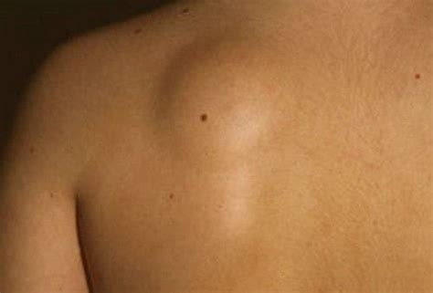 Вітаємо на офіційній сторінці об'єднання професіональних футбольних клубів україни в instagram #упл upl.ua. Подкожное уплотнение на коже человека и причины их ...