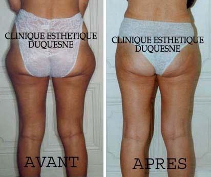 Votre lipoaspiration ventre tout compris à prix pas cher pour obtenir un pour les personnes souhaitant effectuer une liposuccion ventre france, il est à savoir que les prix. Liposuccion douce ou liposculpture à Lyon | Clinique Duquesne