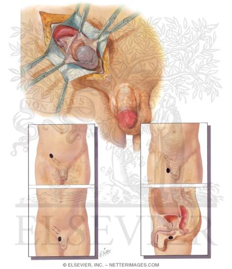 Intersex across the animal kingdom. Malposition of the Testicle