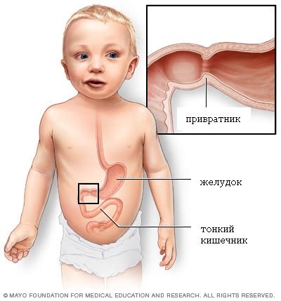 Rotavirus causes an acute gastroenteritis in infants and young children and is associated with profuse watery diarrhoea, projectile vomiting and fever. Стеноз привратника желудка (пилоростеноз) у детей ...